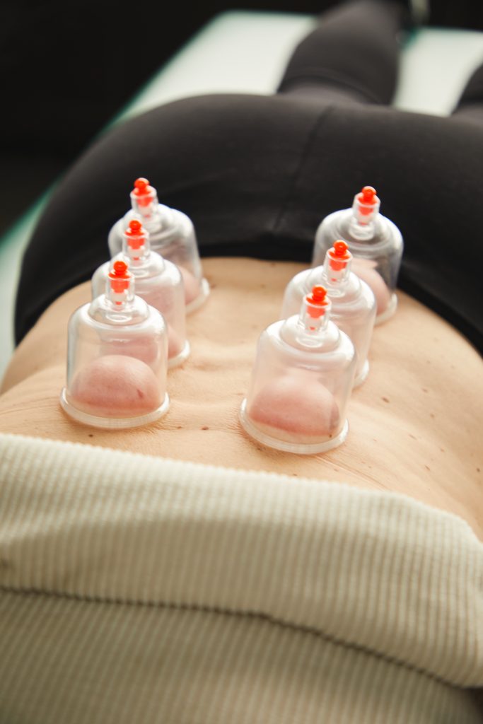 Cupping Therapy Near Me Cupping Treatment Bensalem, PA New Heights